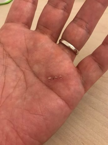 ゴルフを始めたら左手小指がバネ指になったので手術をしてみた体験談。